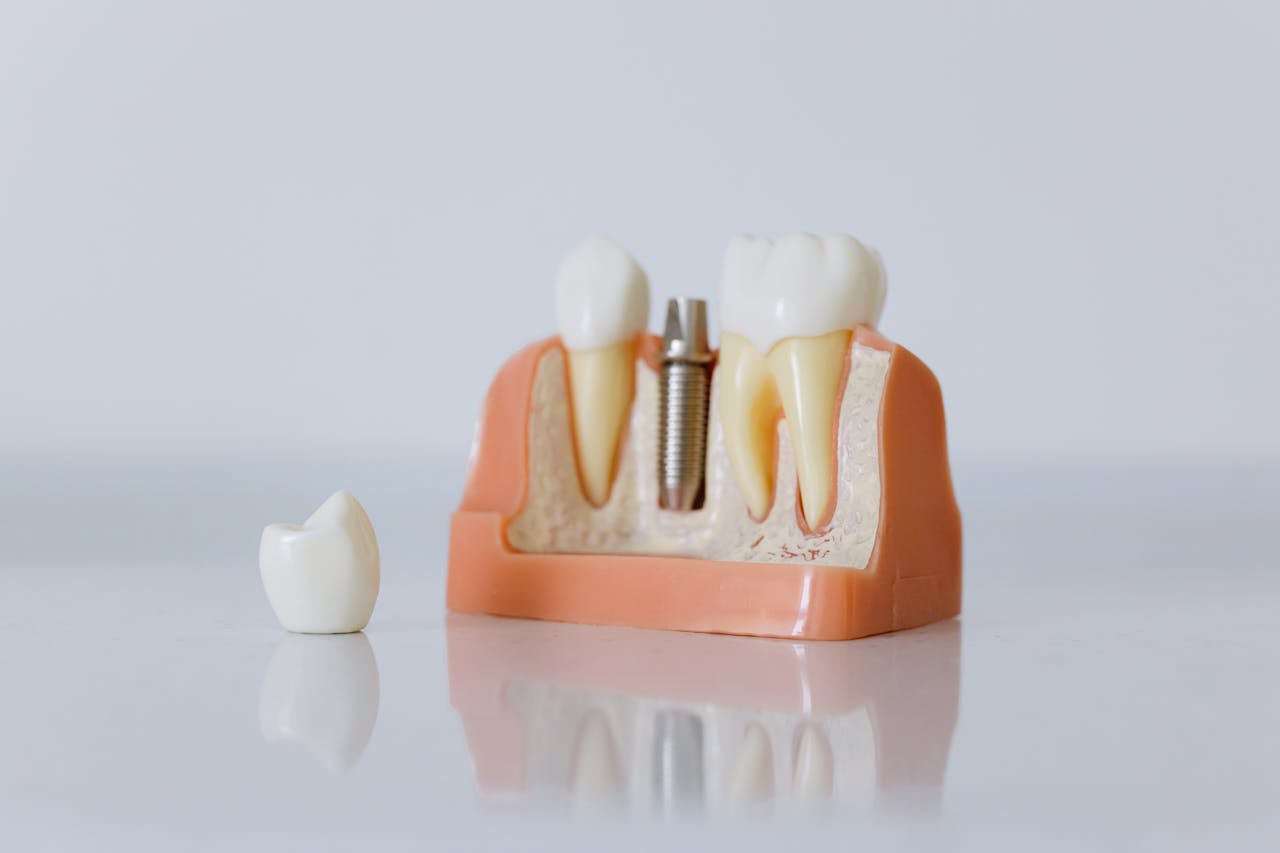 W jakich przypadkach warto zdecydować się na implanty zębów?